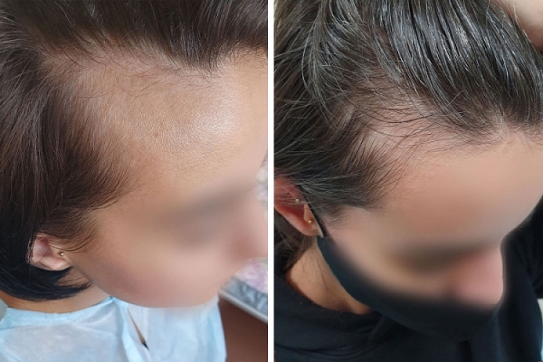 Как белорусы пересаживают волосы