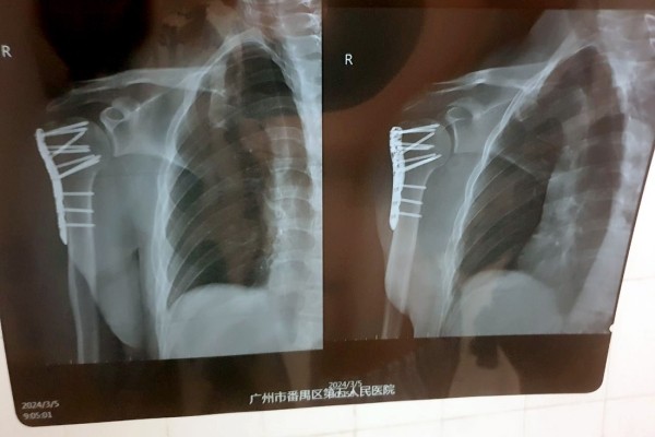 Белорус попал в аварию в Китае и испытал на себе особенности местной медицины